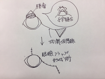 犬の大きな眼瞼腫瘍切除と眼瞼フラップ形成術　　　　　　　　　　マイボーム腺癌